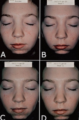 tazarotene crema